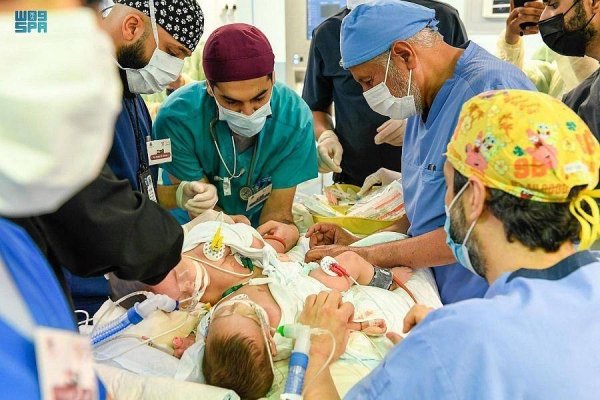 A team of surgeons separates conjoined twins