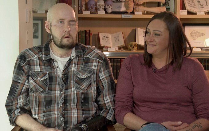 US surgeons perform first whole-eye transplant in the world: Breaking News