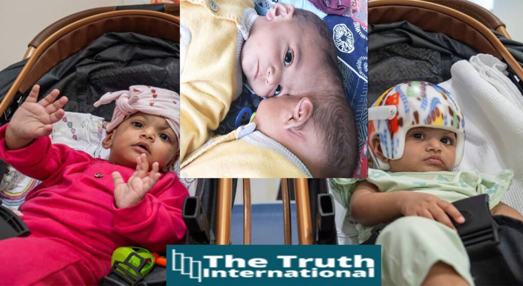Turkish doctors change fate of conjoined Pakistani twins Mirha and Minal after 14-hour surgery