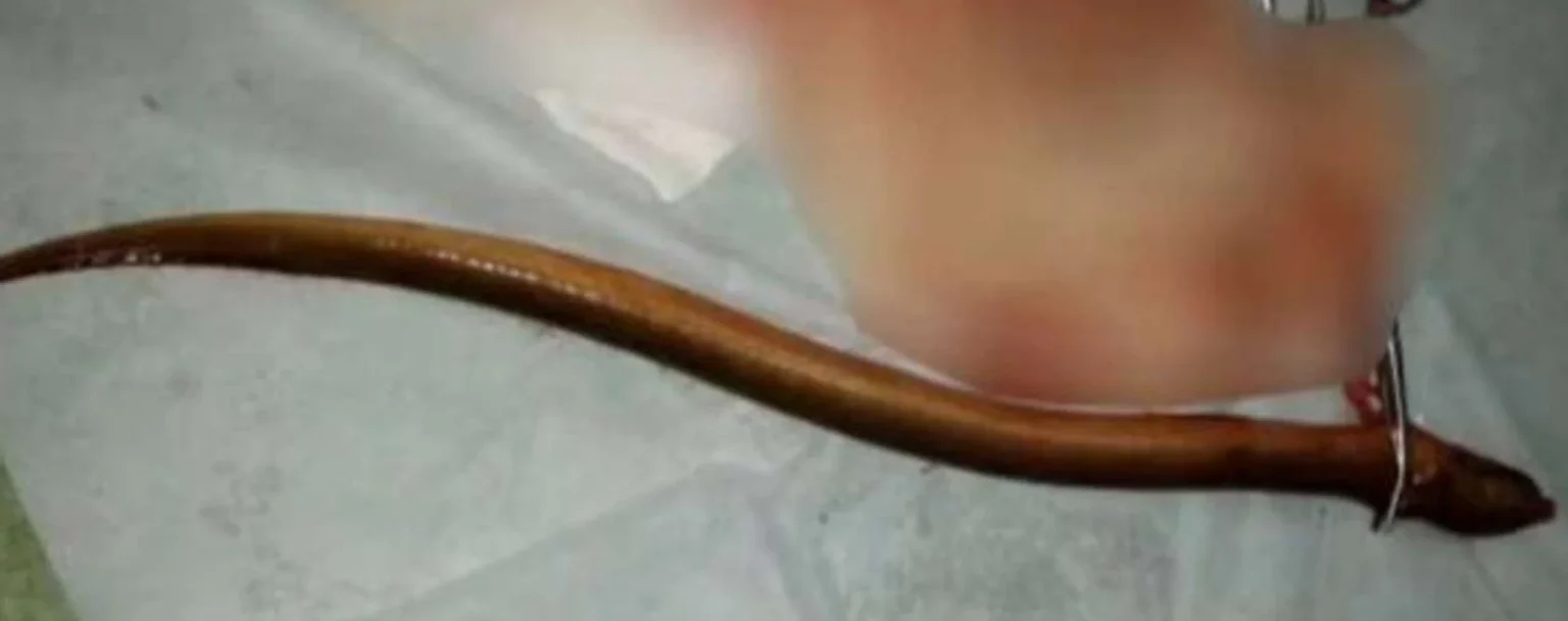 Doctors discover live eel inside man’s abdomen
