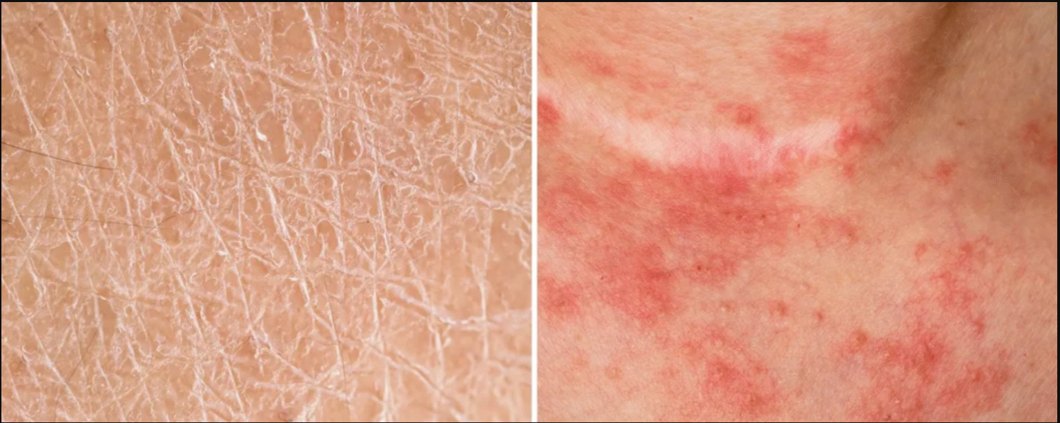 difference between dry skin and eczema