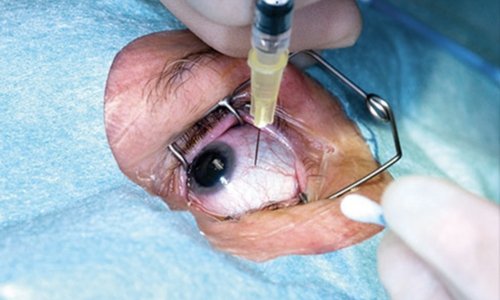 Latest update about Imran Khan’s eye treatment at PIMS Hospital Imran Khan shifted to PIMS for anti-VEGF eye injection; cardiac tests normal, hospital confirms stable condition and discharge.