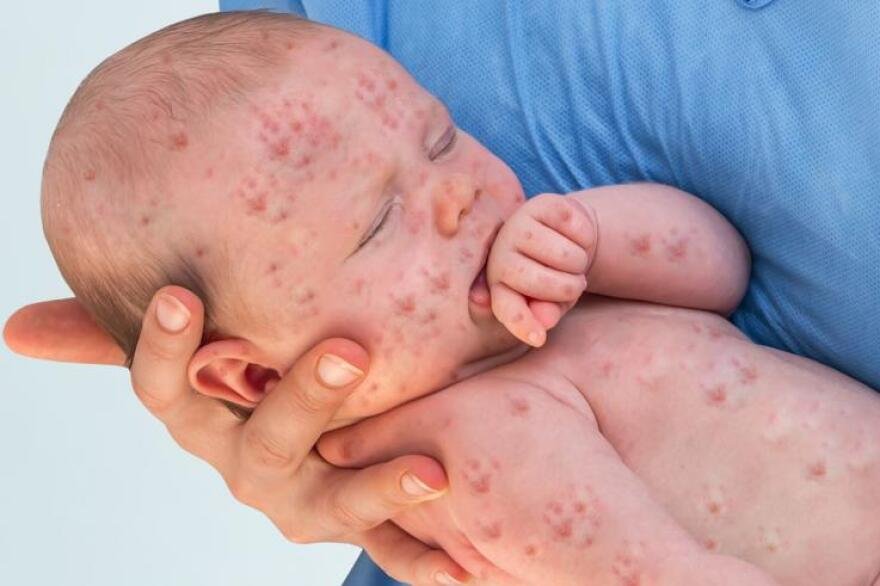 Measles Outbreak Escalates: How to Keep Your Children Safe